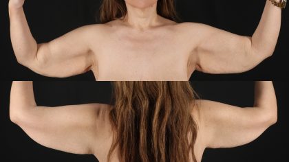 Arm Lift Before & After Patient #4754