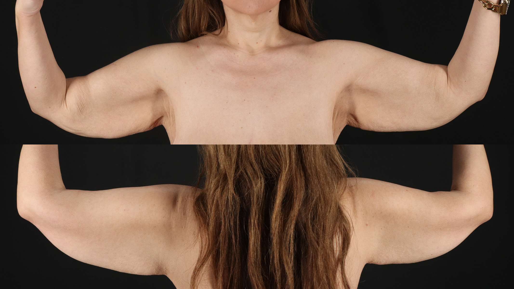 Arm Lift Before & After Patient #4754