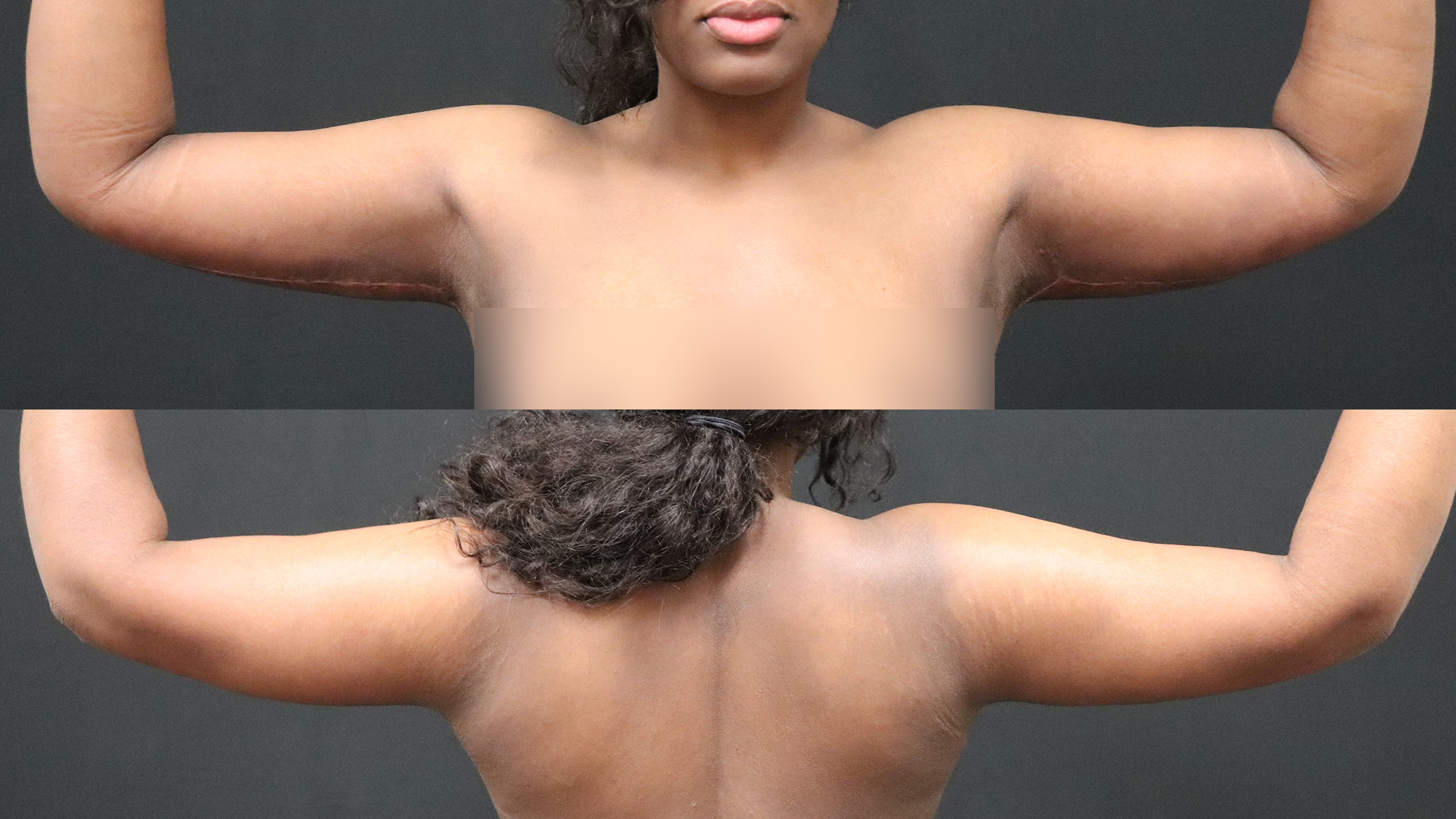 Arm Lift Before & After Patient #4797