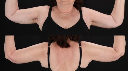 Arm Lift Before & After Patient #4750