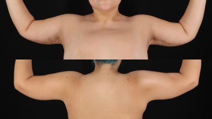Arm Lift Before & After Patient #4796