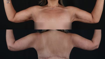Arm Lift Before & After Patient #4821