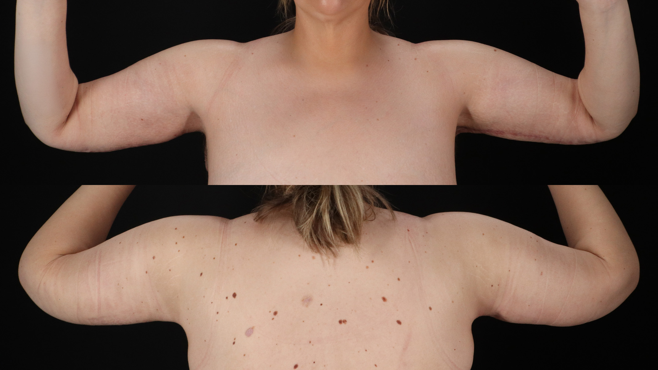Arm Lift Before & After Patient #4826