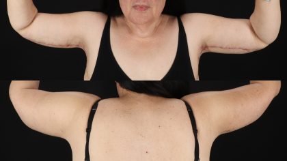 Arm Lift Before & After Patient #4753