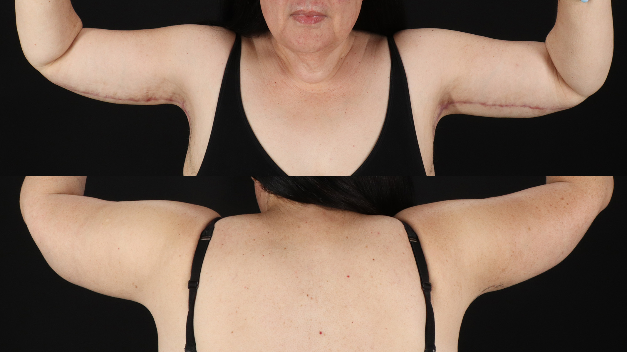 Arm Lift Before & After Patient #4753