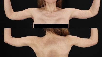 Arm Lift Before & After Patient #4754