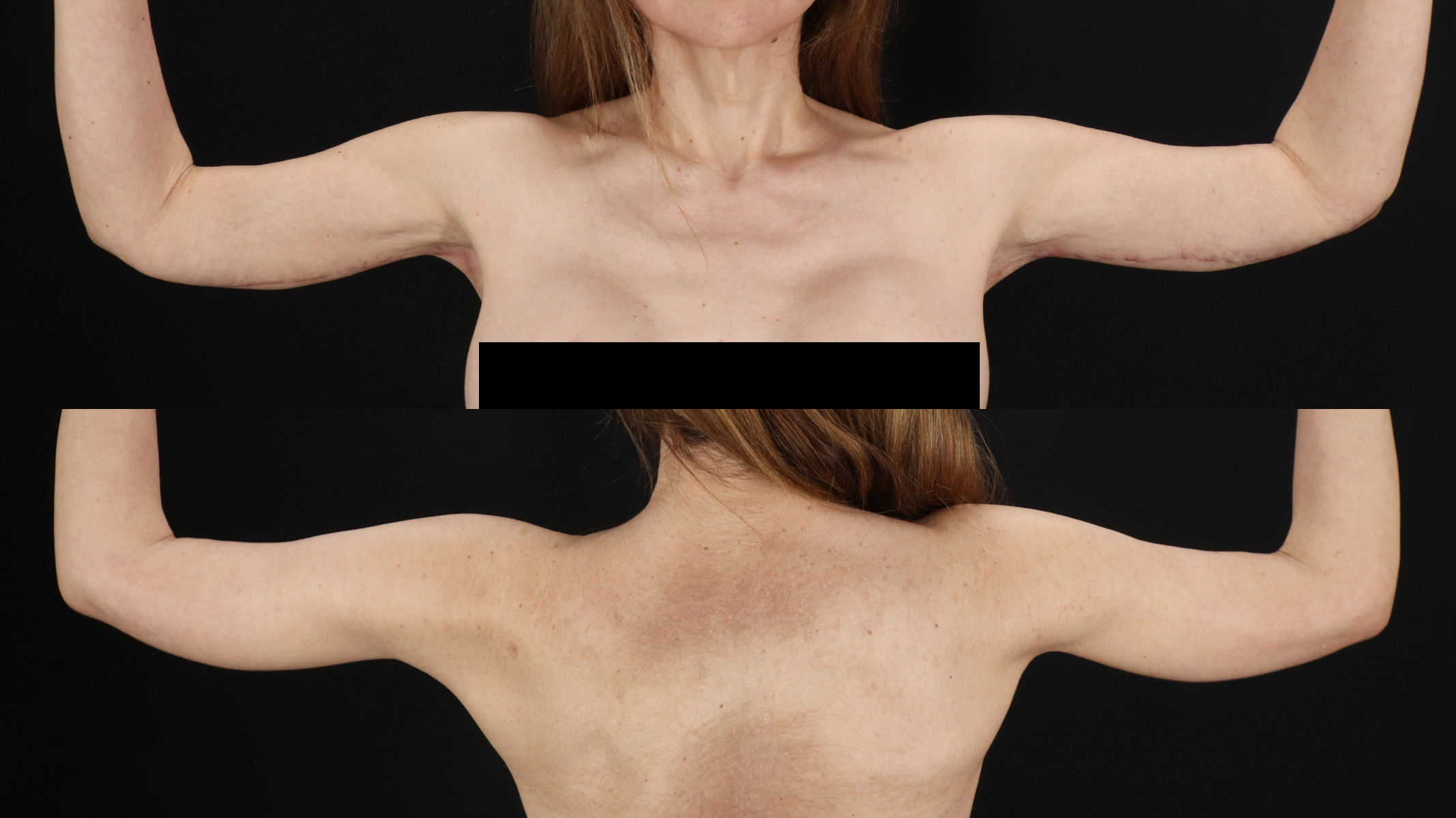 Arm Lift Before & After Patient #4754