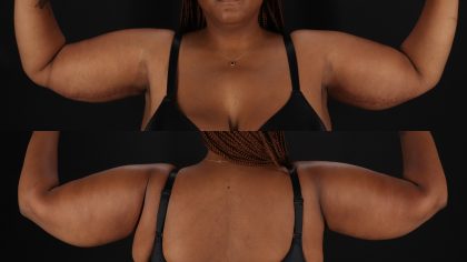 Arm Lift Before & After Patient #4792