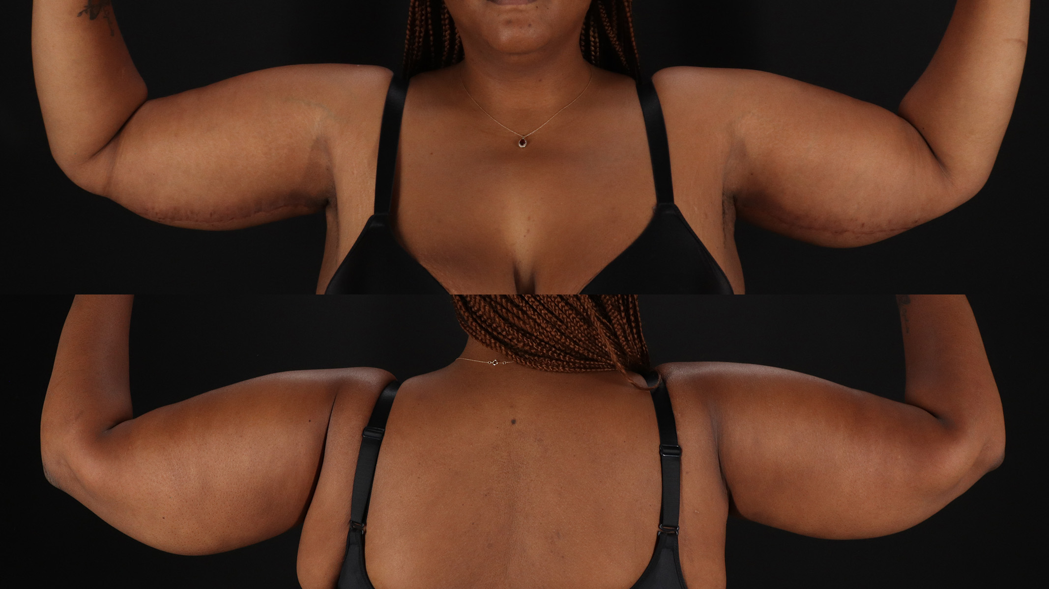 Arm Lift Before & After Patient #4792