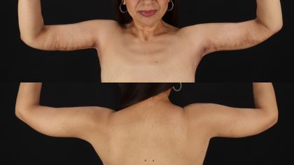 Arm Lift Before & After Patient #4752