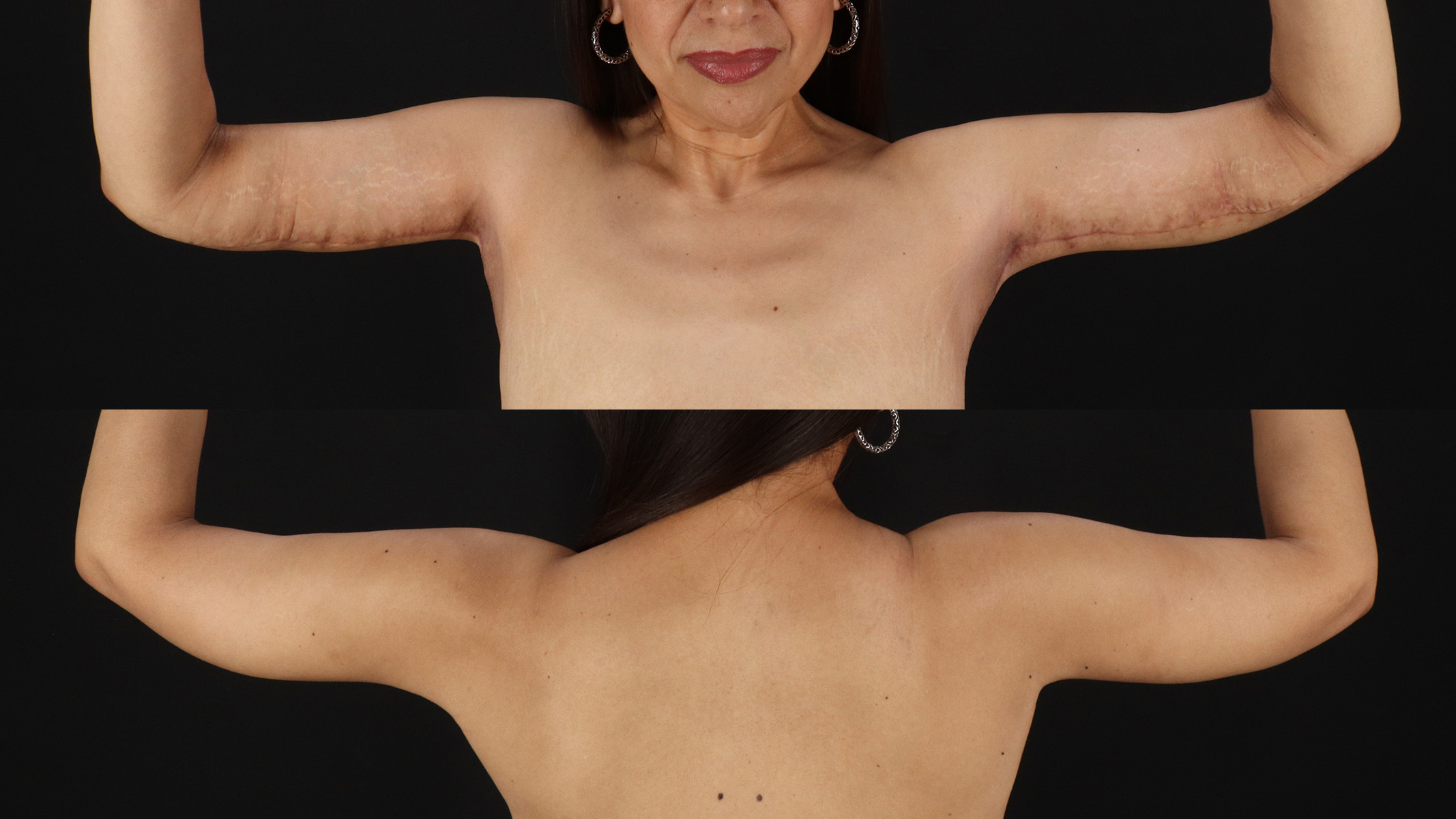 Arm Lift Before & After Patient #4752