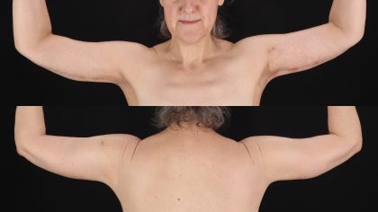 Arm Lift Before & After Patient #4788