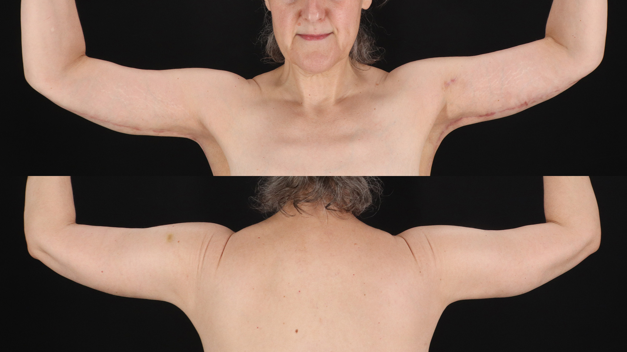 Arm Lift Before & After Patient #4788