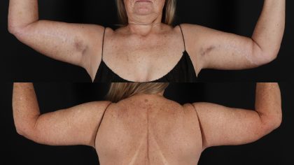 Arm Lift Before & After Patient #4755