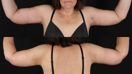 Arm Lift Before & After Patient #4822