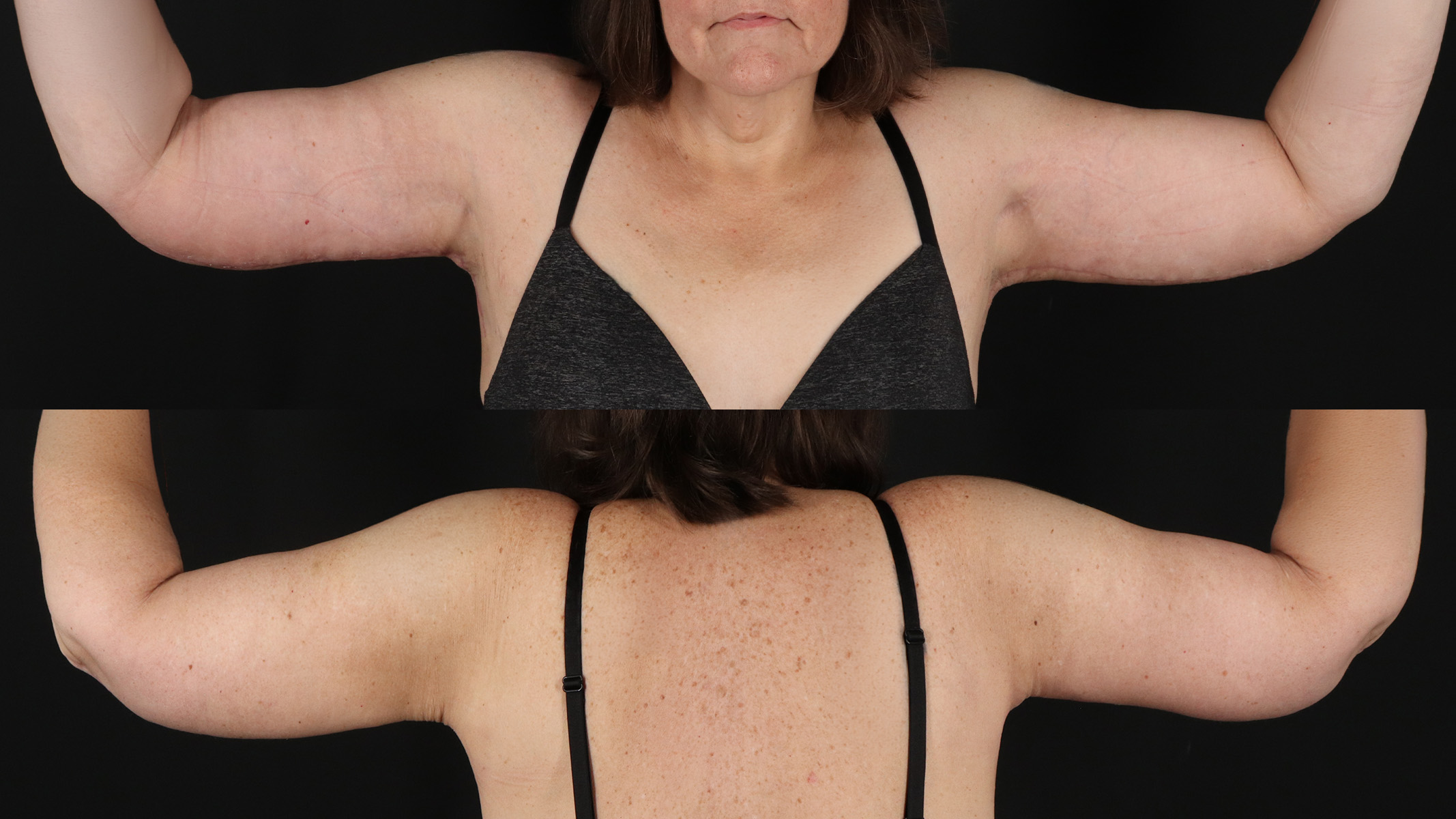 Arm Lift Before & After Patient #4822