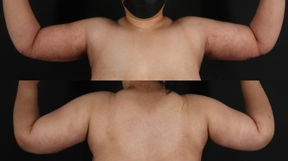 Arm Lift Before & After Patient #4789