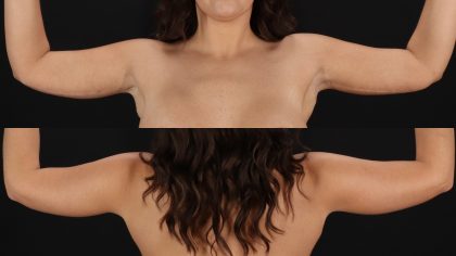 Arm Lift Before & After Patient #4758
