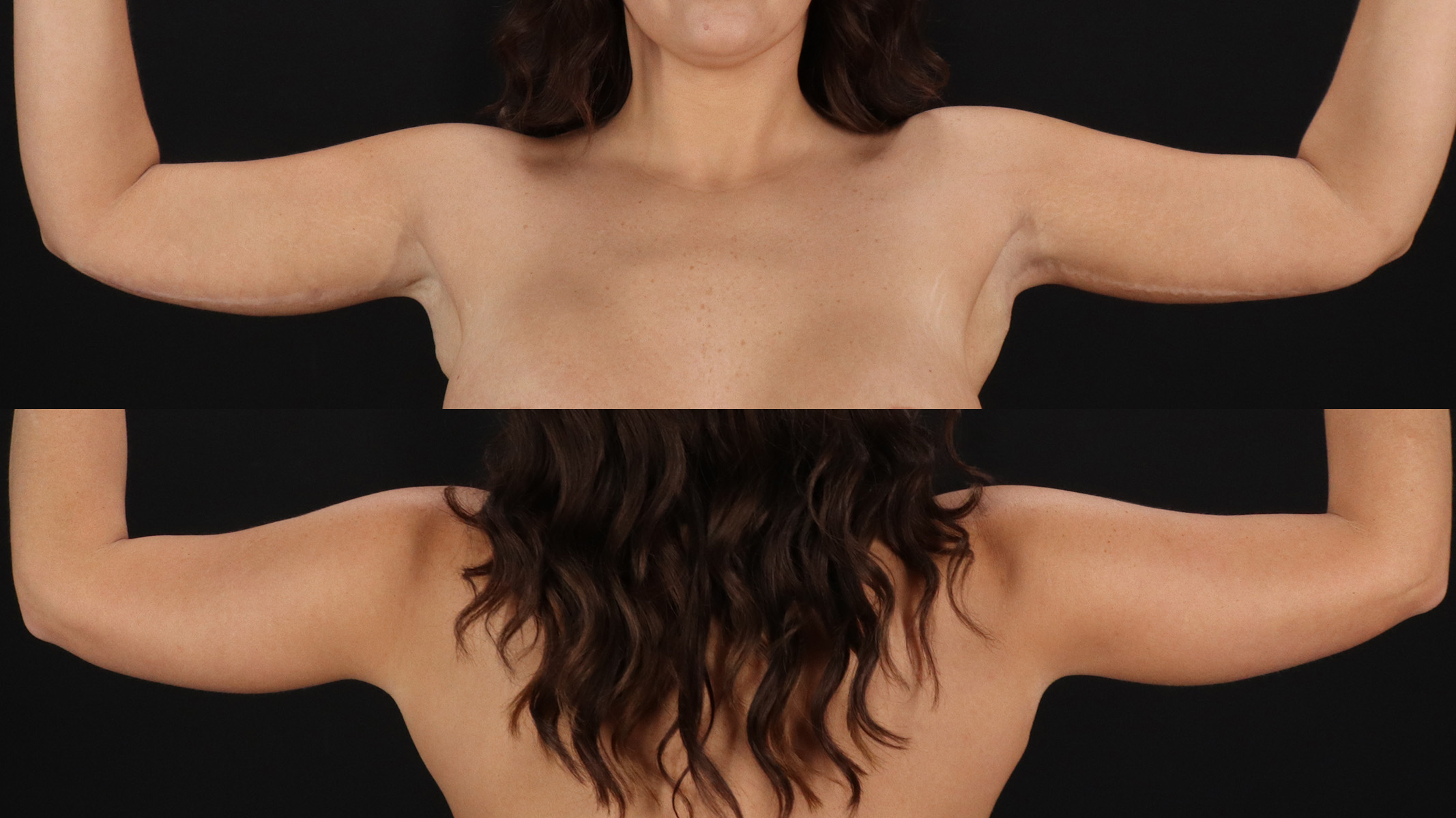 Arm Lift Before & After Patient #4758