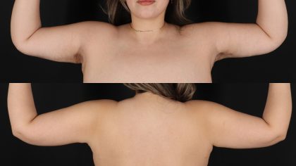 Arm Lift Before & After Patient #4820
