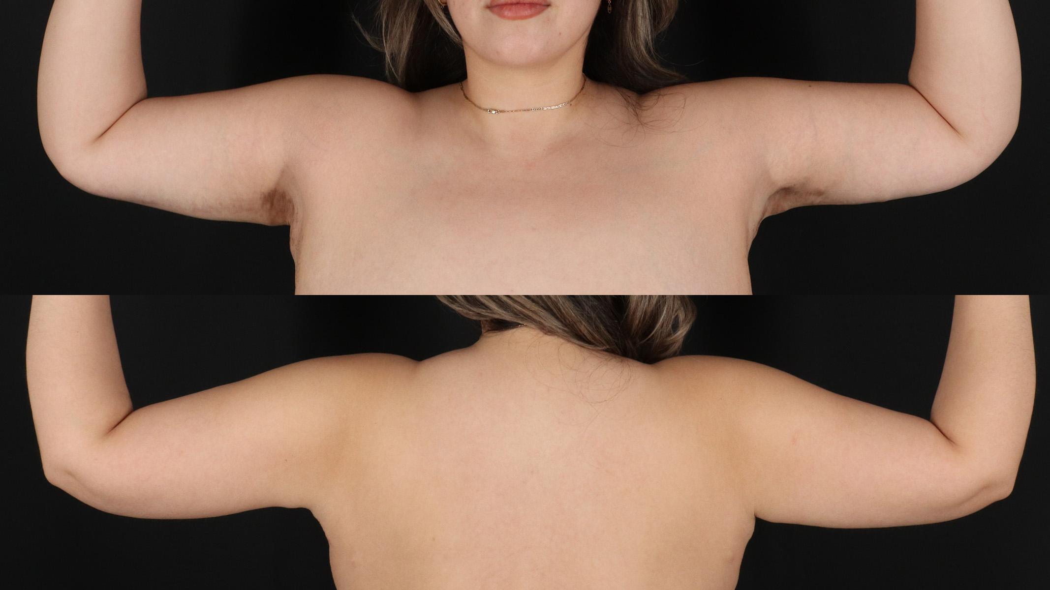 Arm Lift Before & After Patient #4820