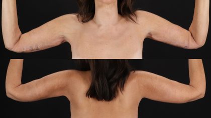 Arm Lift Before & After Patient #4824