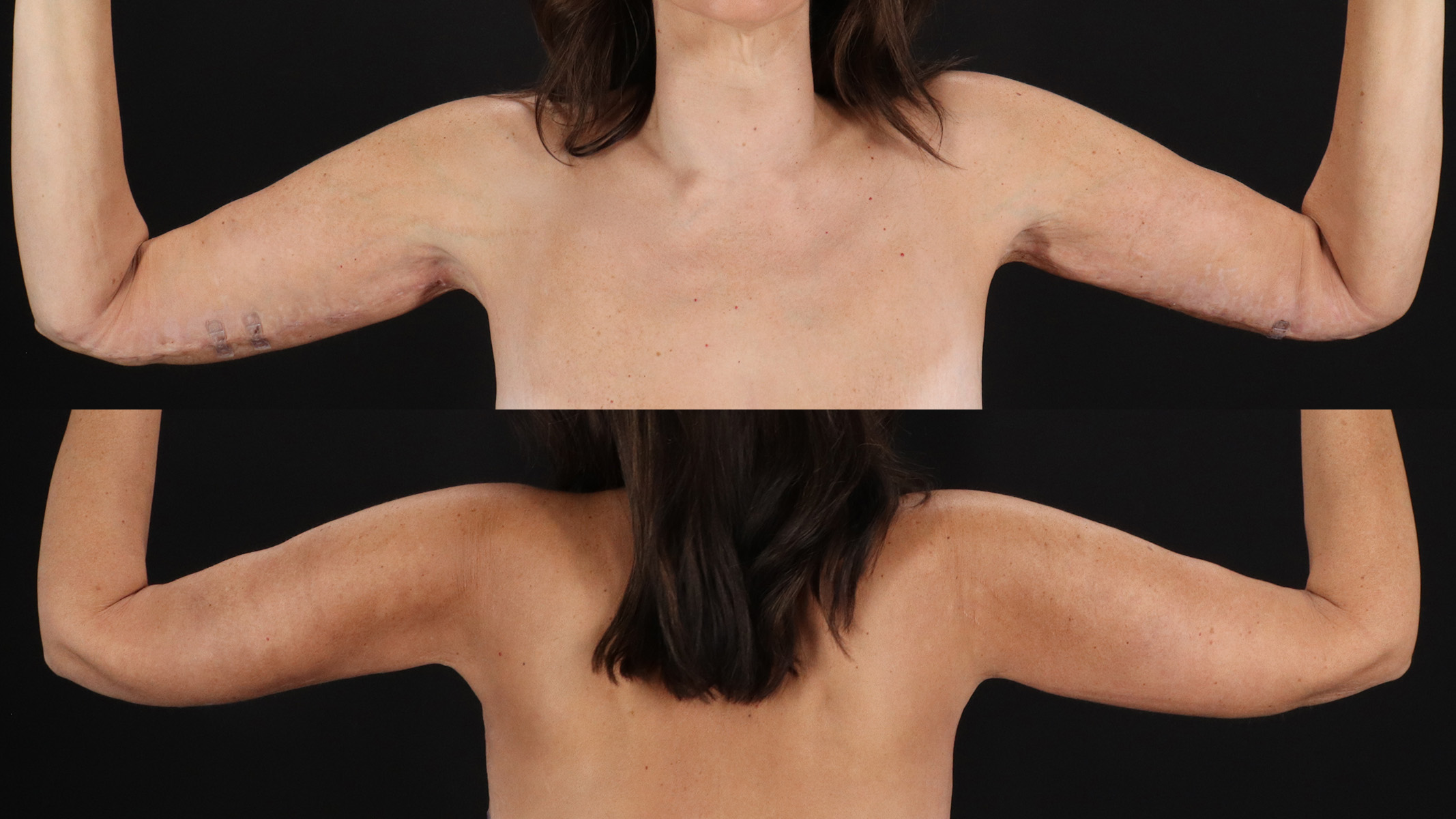 Arm Lift Before & After Patient #4824