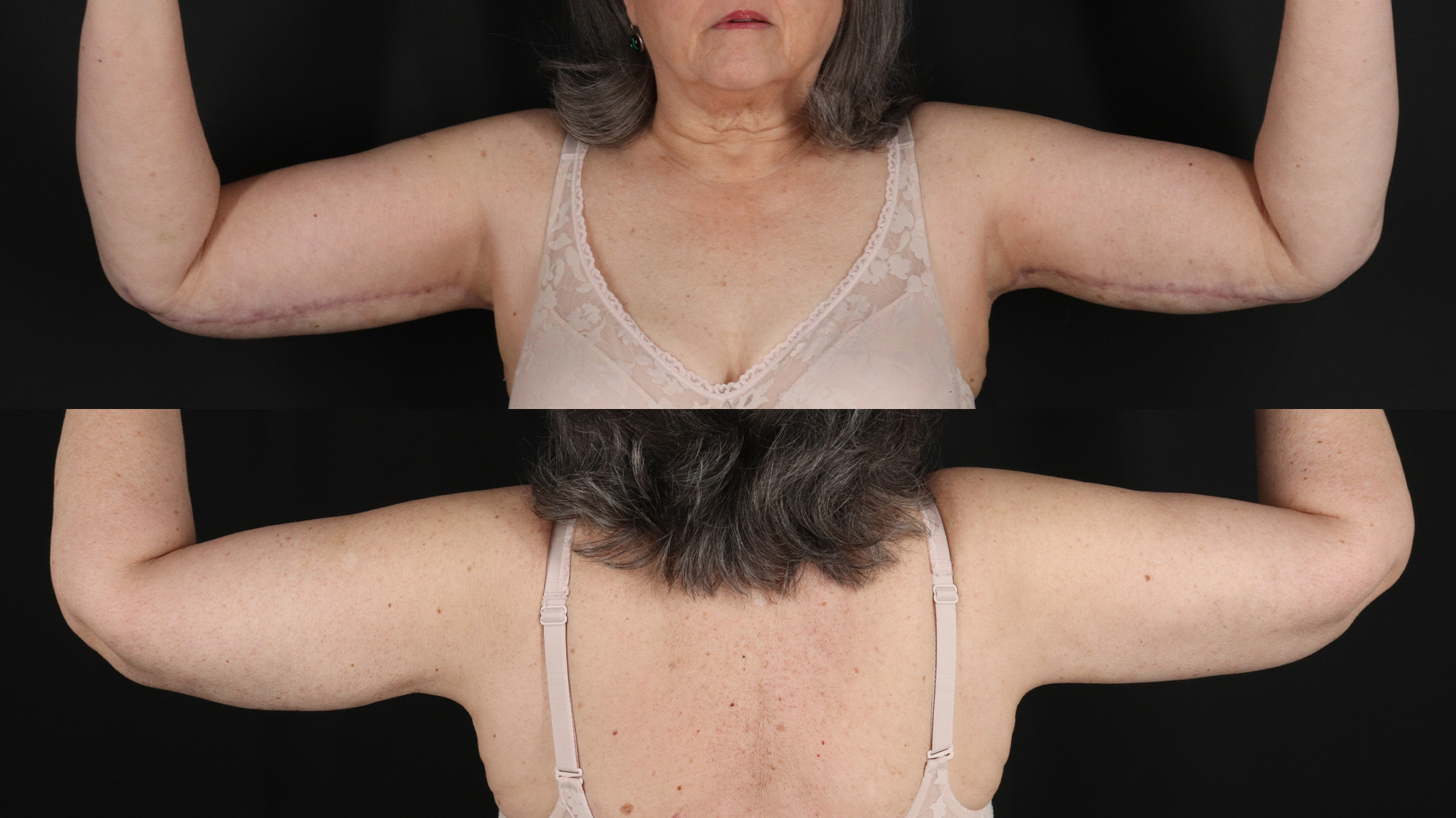 Arm Lift Before & After Patient #4823