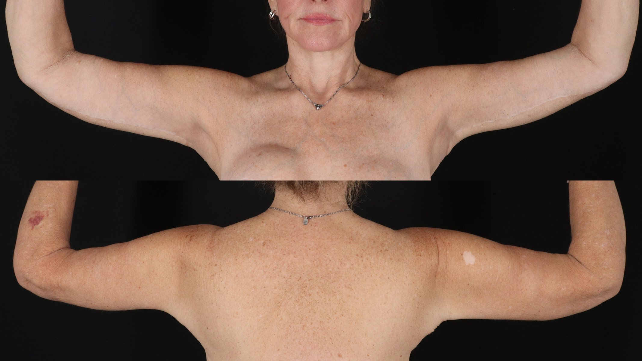 Arm Lift Before & After Patient #4751