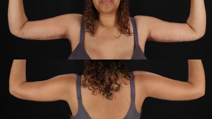 Arm Lift Before & After Patient #4828