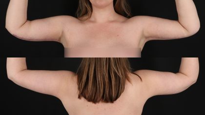 Arm Lift Before & After Patient #4825