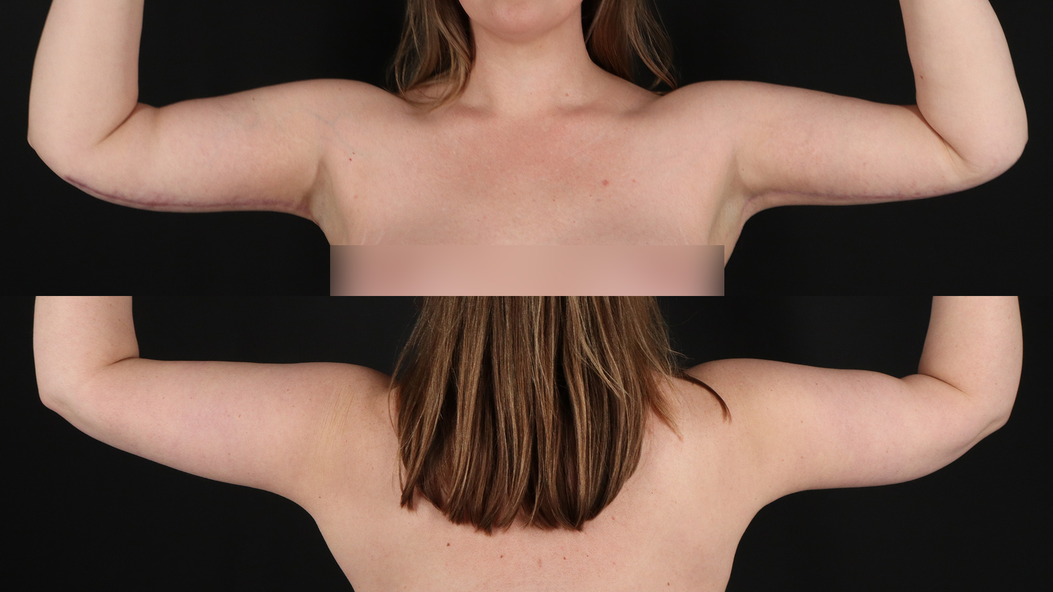 Arm Lift Before & After Patient #4825