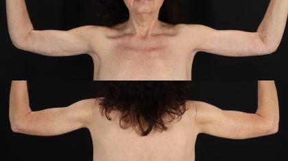 Arm Lift Before & After Patient #4795