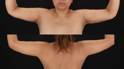 Arm Lift Before & After Patient #4749