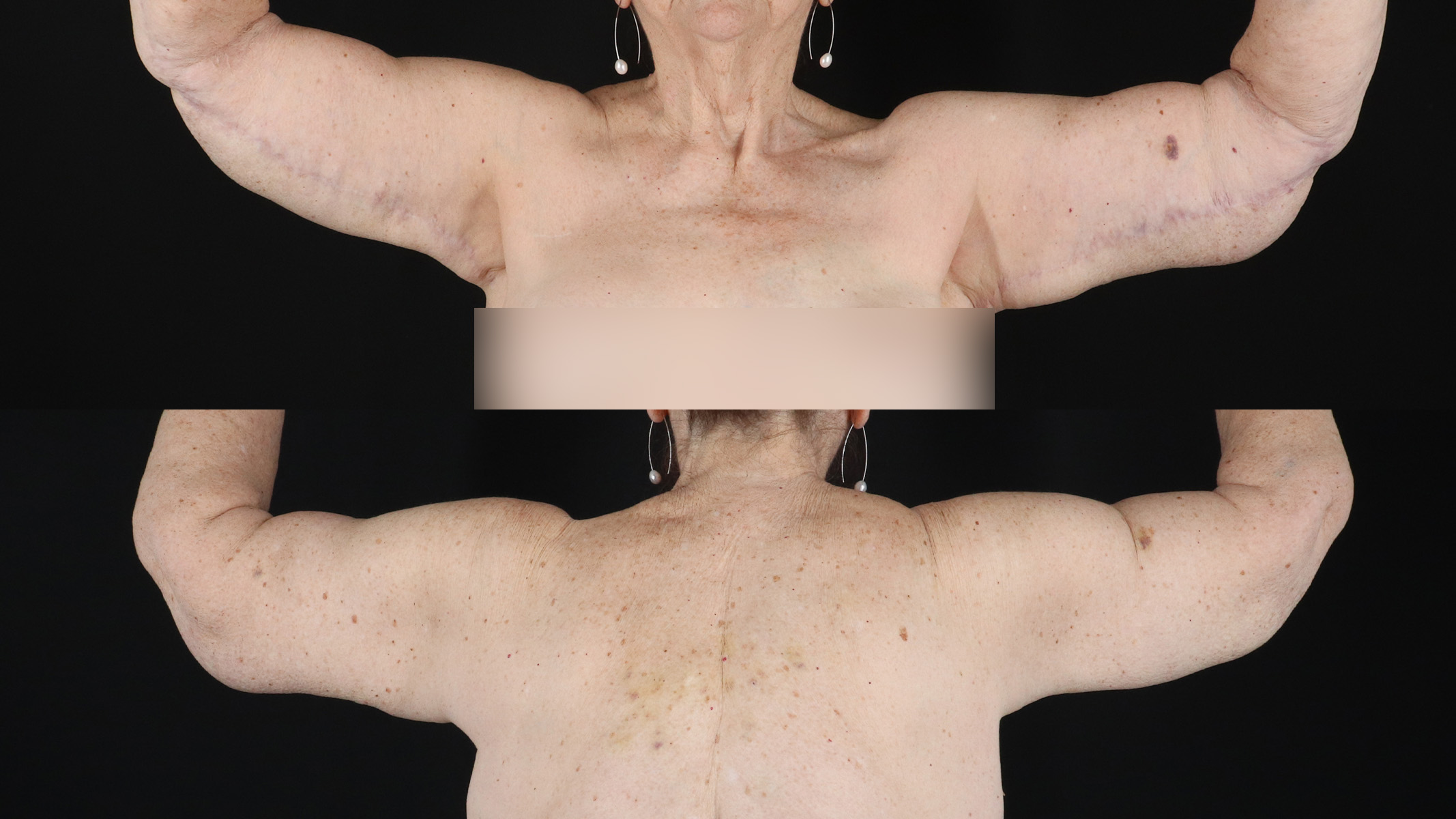 Arm Lift Before & After Patient #4794