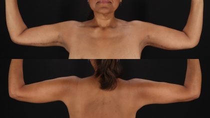 Arm Lift Before & After Patient #4790