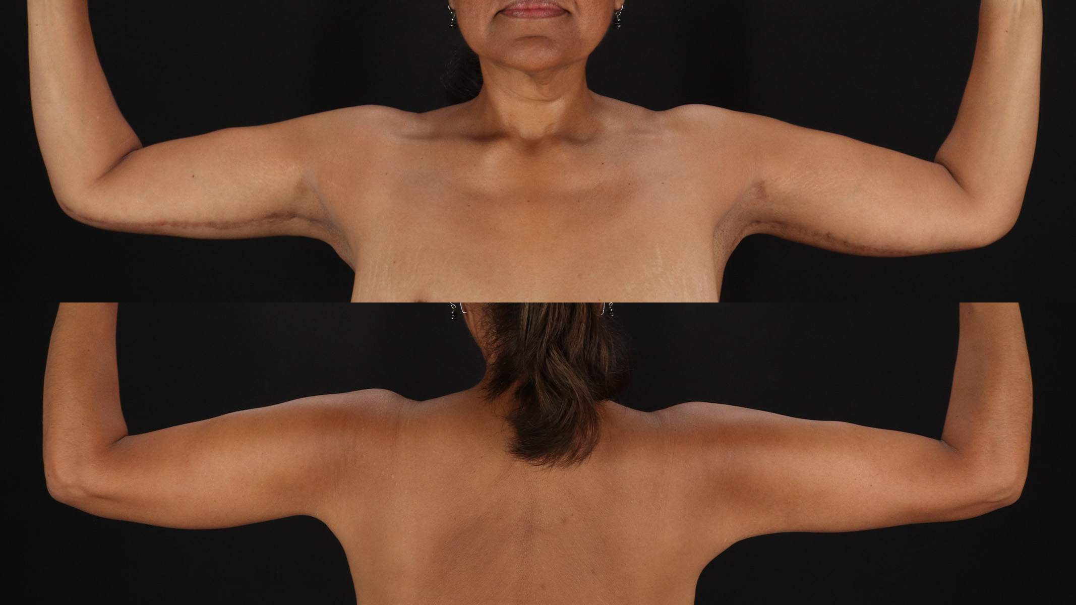 Arm Lift Before & After Patient #4790