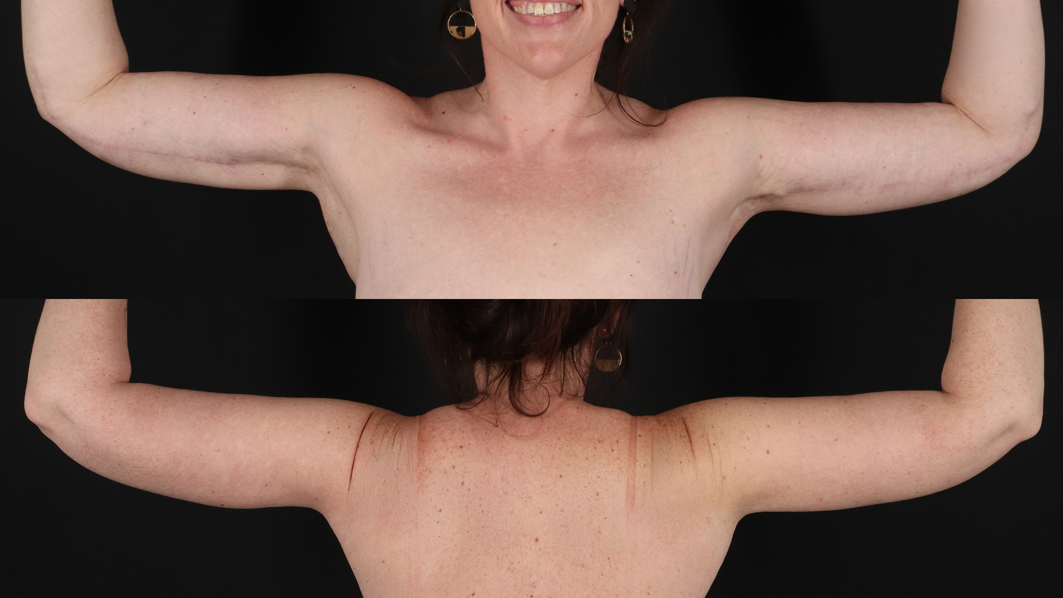 Arm Lift Before & After Patient #4757