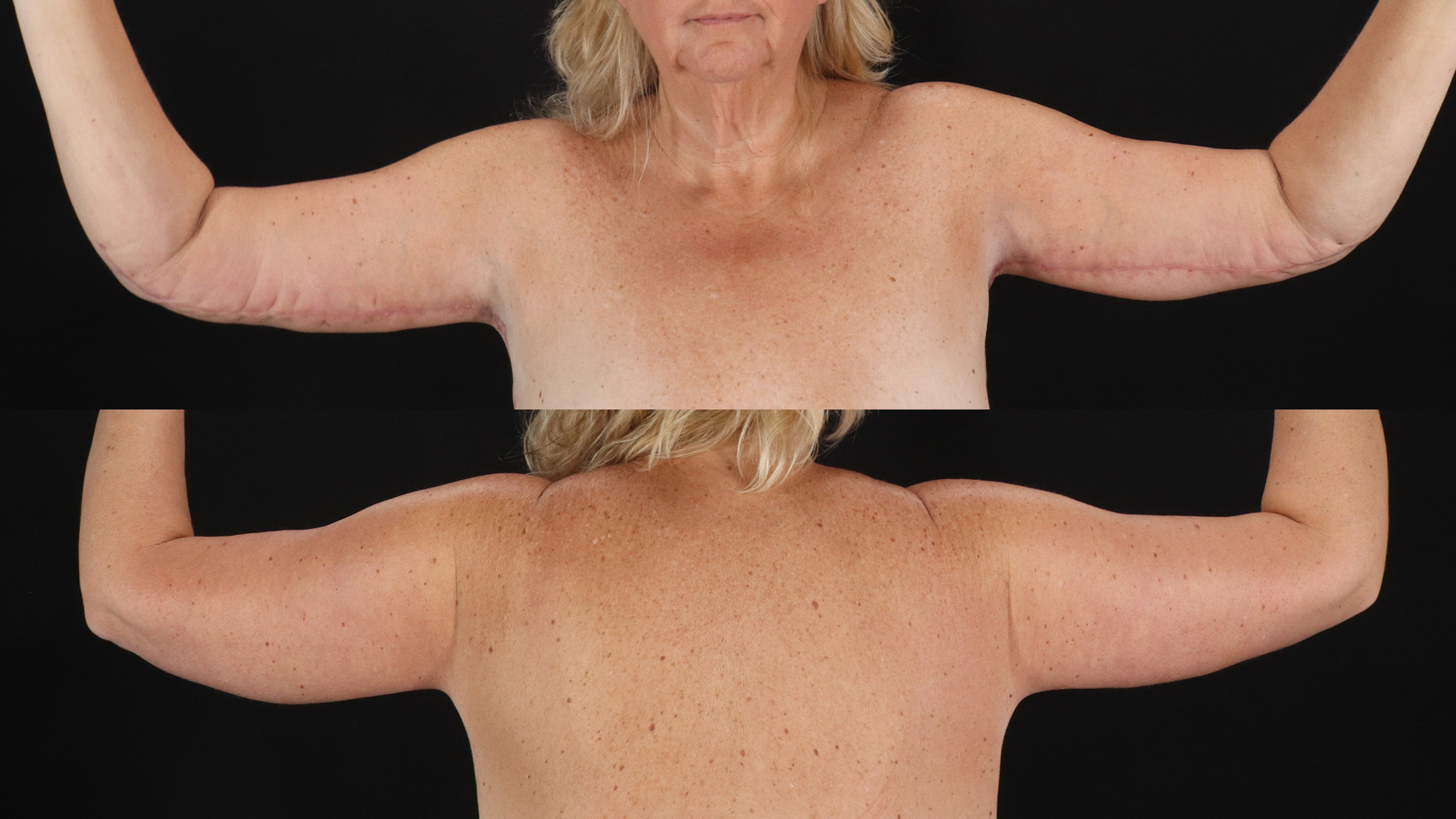 Arm Lift Before & After Patient #4827