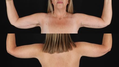Arm Lift Before & After Patient #4793