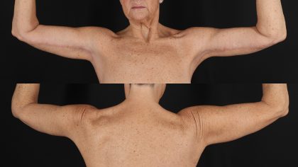 Arm Lift Before & After Patient #4791