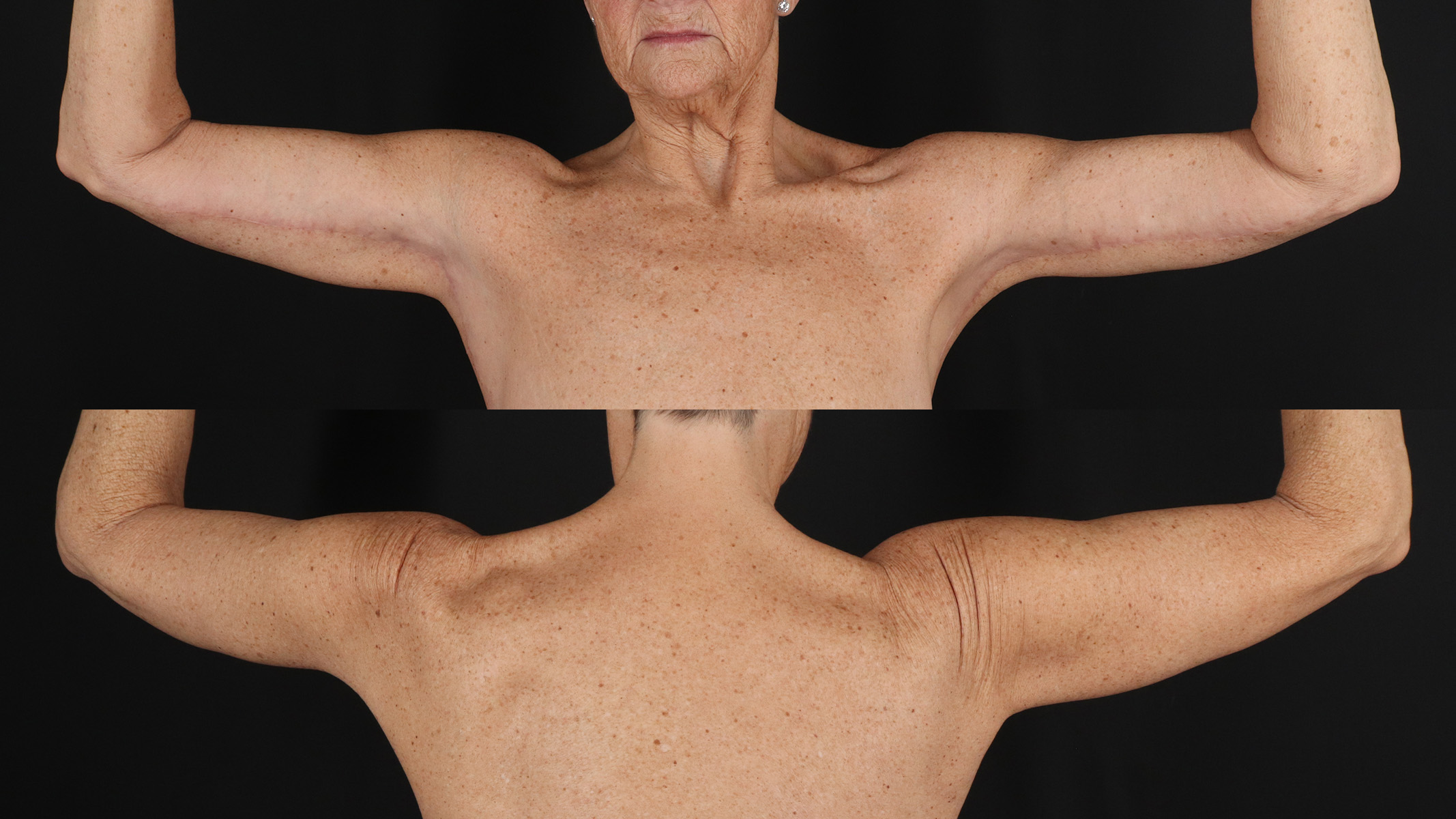 Arm Lift Before & After Patient #4791