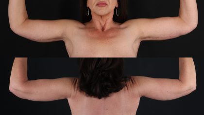 Arm Lift Before & After Patient #4756