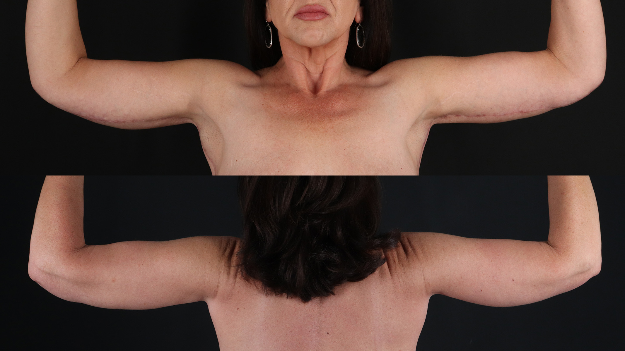 Arm Lift Before & After Patient #4756