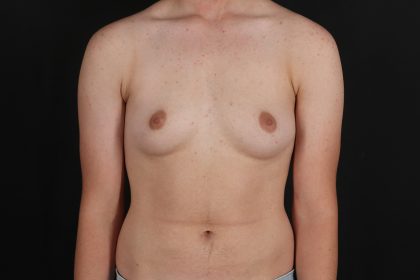 FTM Chest Contouring Before & After Patient #4872