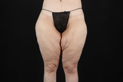 Massive Weight Loss Before & After Patient #5050