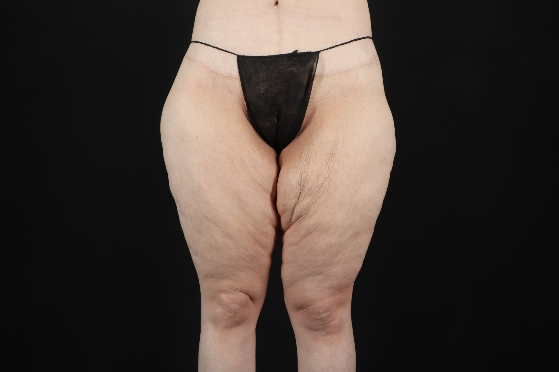 Massive Weight Loss Before & After Patient #5050