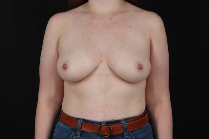 Breast Augmentation - Implant Before & After Patient #4868