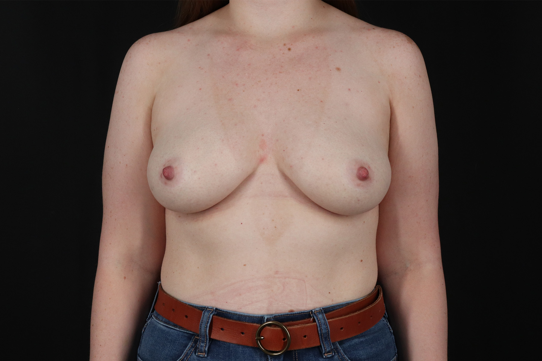 Breast Augmentation - Implant Before & After Patient #4868
