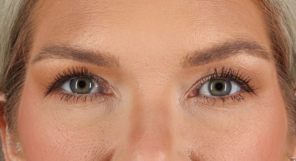 Blepharoplasty (Eyelid Surgery) Before & After Patient #4870